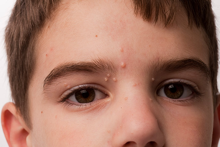 Molluscum Contagiosum skin rash in children