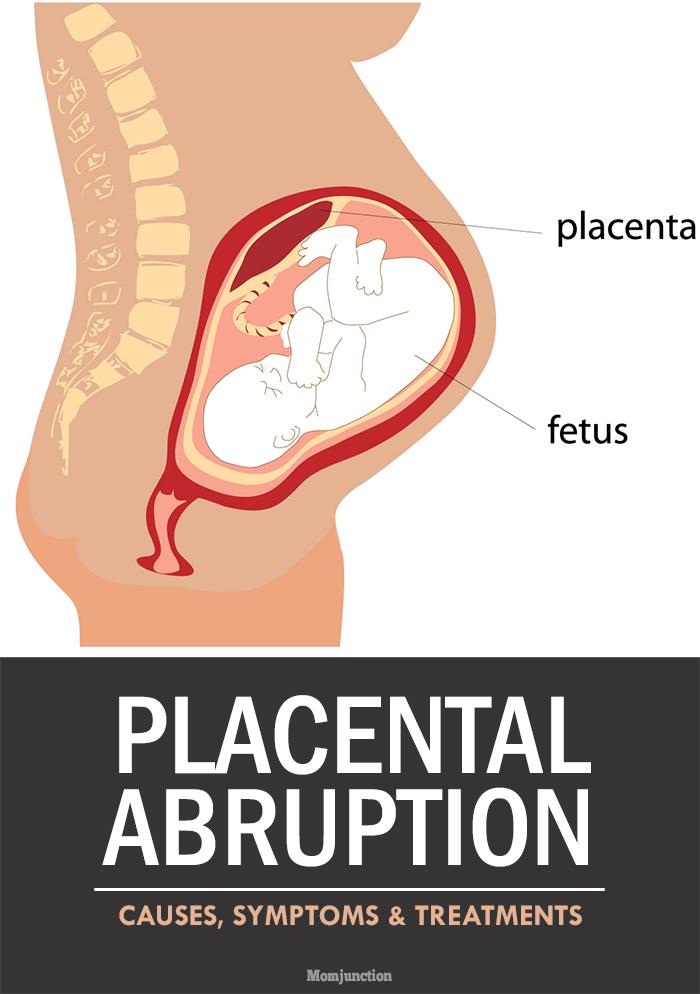 Placental Abruption Causes, Symptoms And Treatment