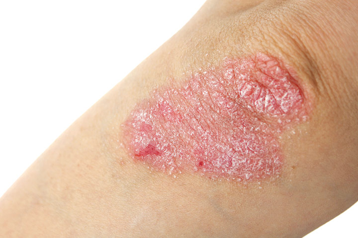 Psoriasis skin rash in children