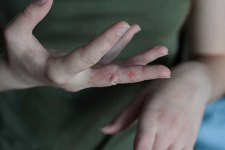 Scabies skin rash in children