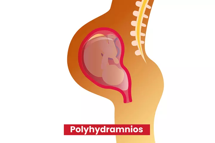 Amniocentesis can help with polyhydroamnios