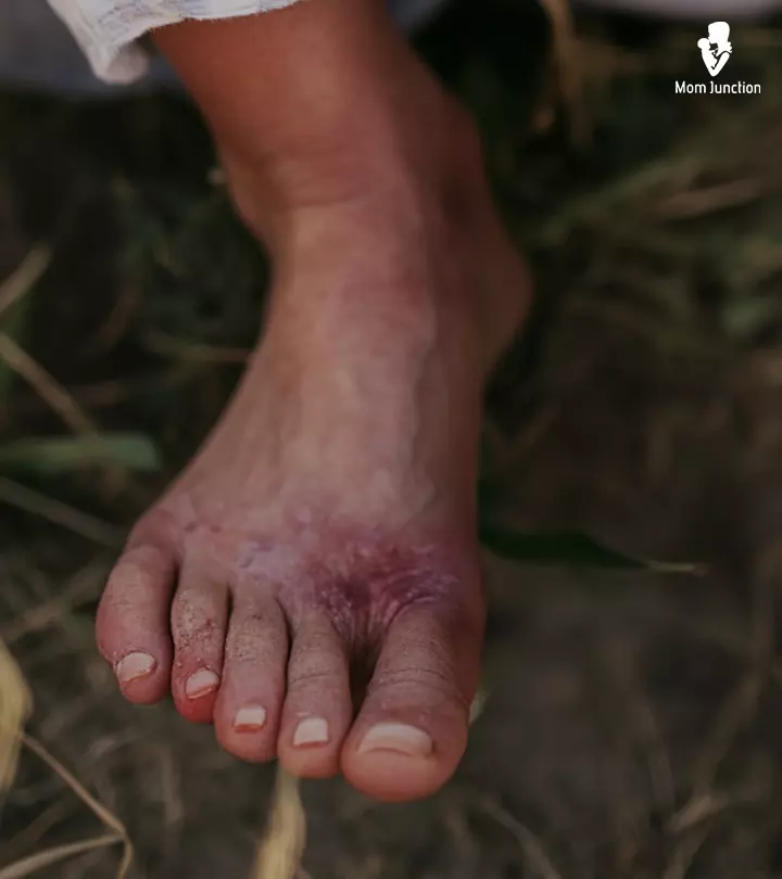 Pregnant Women Suffering From Athlete's Foot