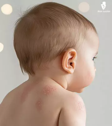 Each type of rash in babies has different causes and so are their symptoms.