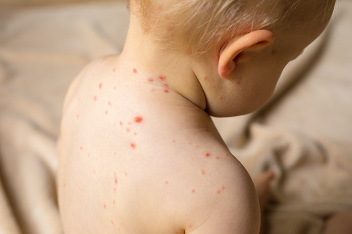 Rashes in babies due to chickenpox