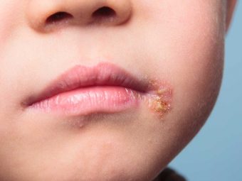 Cold Sores (Fever Blisters) In Kids: Causes And Treatment