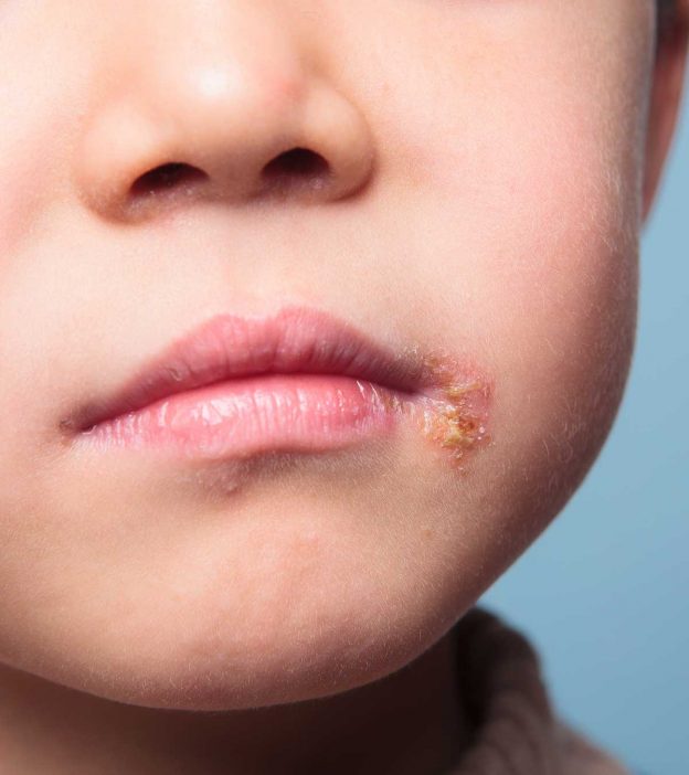 Cold Sores (Fever Blisters) In Kids: Causes And Treatment