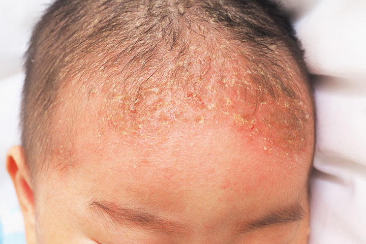 Rashes in babies due to cradle cap