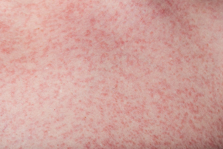Rashes in babies due to dengue