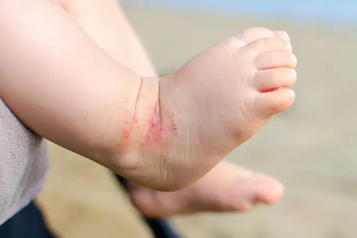 Eczema rashes in babies