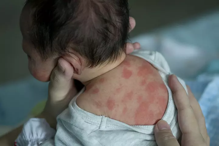 Rashes in babies due to Erythema toxicum