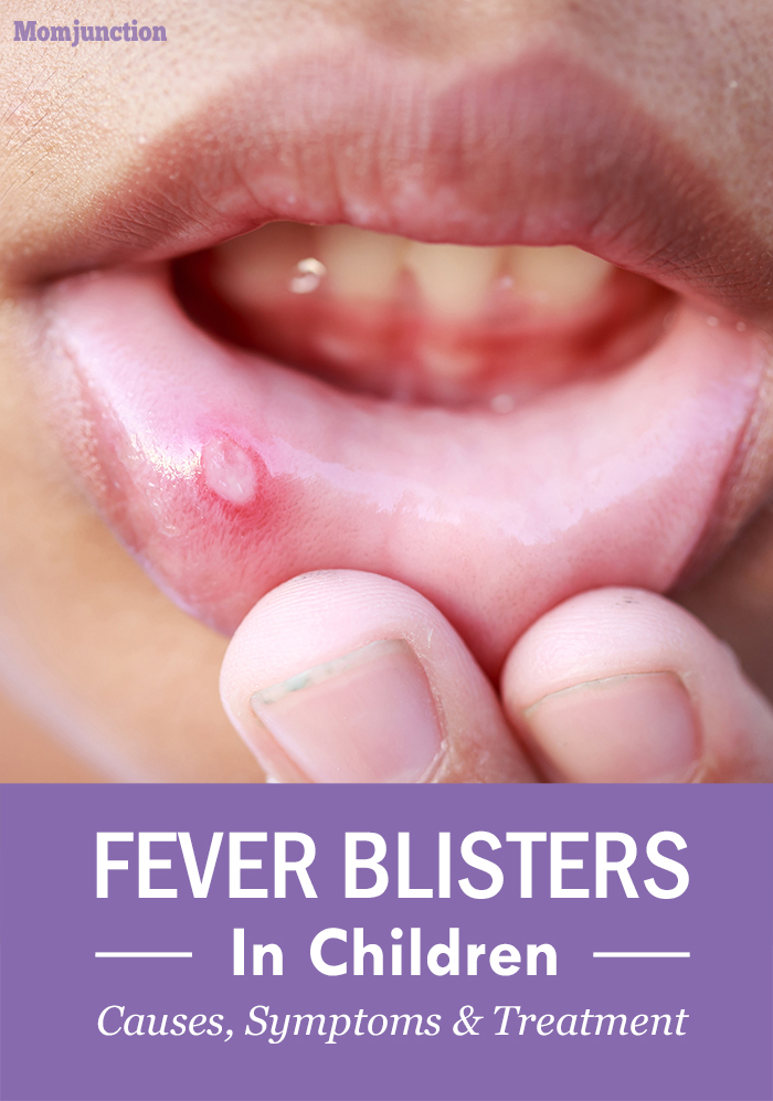 Cold Sores Fever Blisters In Kids Causes And Treatment