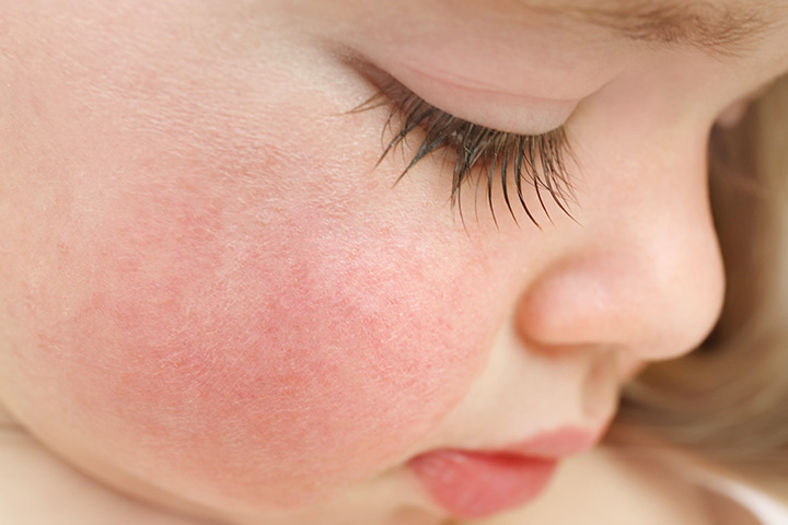 Rashes in babies due to the fifth disease