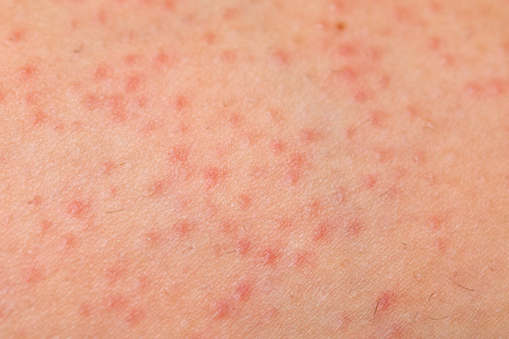 Rashes in babies due to folliculitis