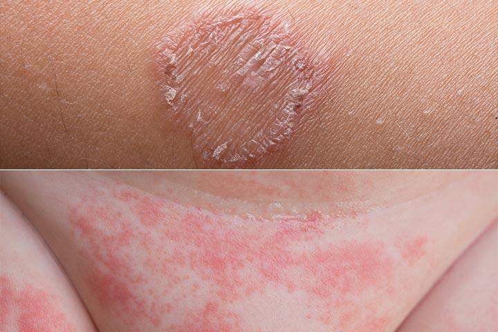 Rashes in babies due to fungal infections