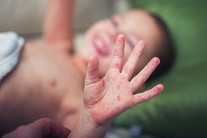Rashes in babies due to hand, foot, and mouth disease