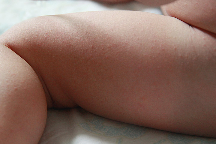 Heat rashes in babies