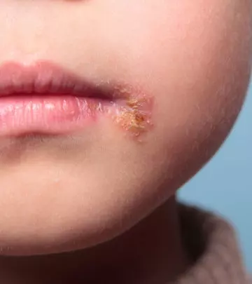Impetigo-In-Children-What-Are-Its-Symptoms-And-How-To-Deal-With-It