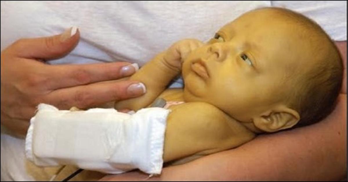 jaundice-in-newborns-causes-symptoms-and-treatment