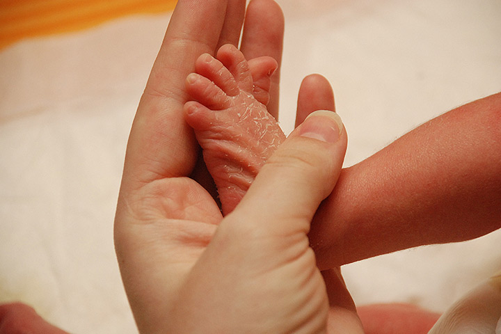 Rashes in babies due to Juvenile Plantar Dermatosis
