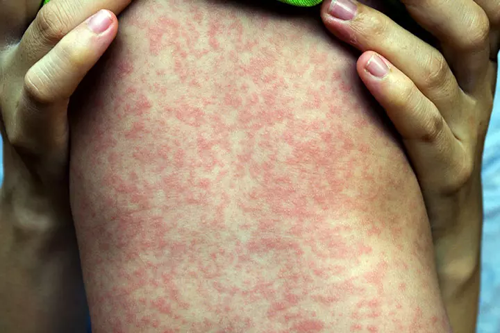 Rashes in babies due to measles