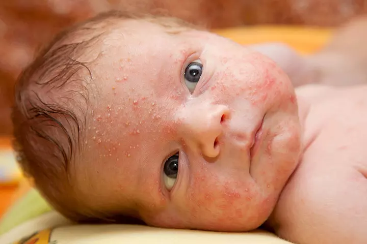Rashes in babies due to neonatal and infantile acne