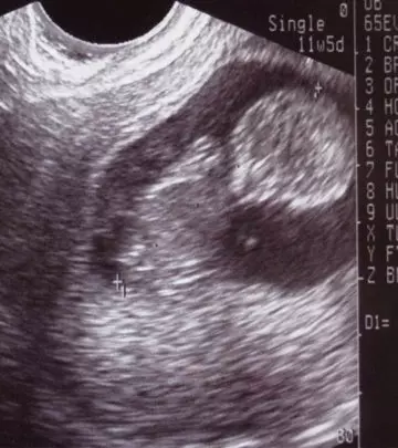 Oops…An Ultrasound Could Get Attention With A Demon In It