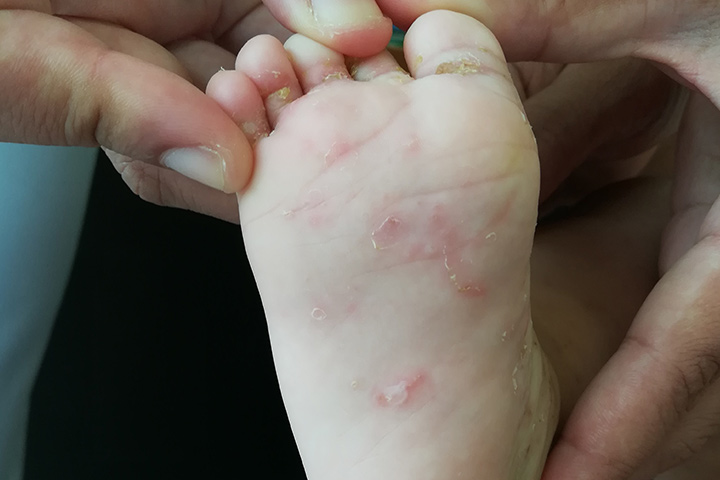 Rashes in babies due to scabies