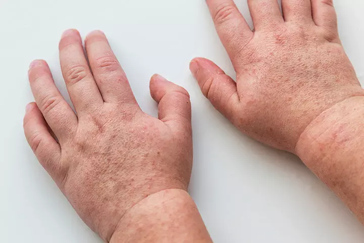 Rashes in babies due to scarlet fever