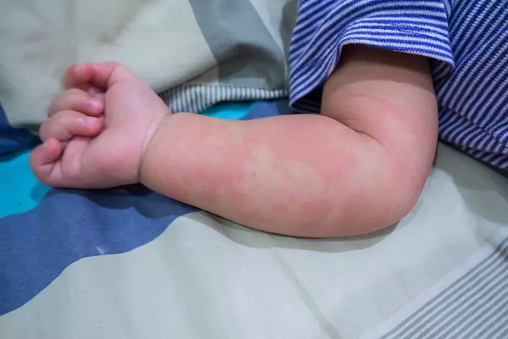Rashes in babies due to skin hives