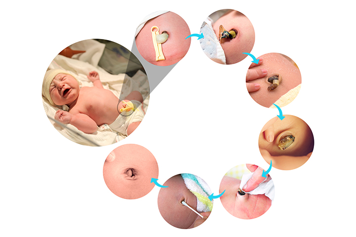 Healing of baby's umbilical cord
