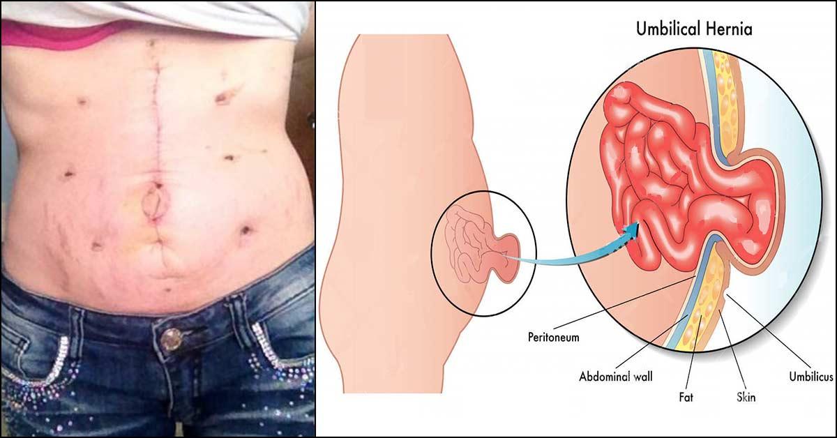 Umbilical Hernia After Pregnancy Causes Symptoms And Treatment