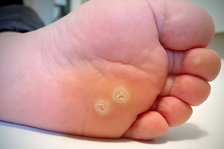 Rashes in babies due to warts