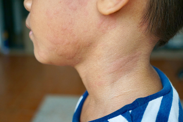 Secondary impetigo may be caused by skin conditions such as eczema