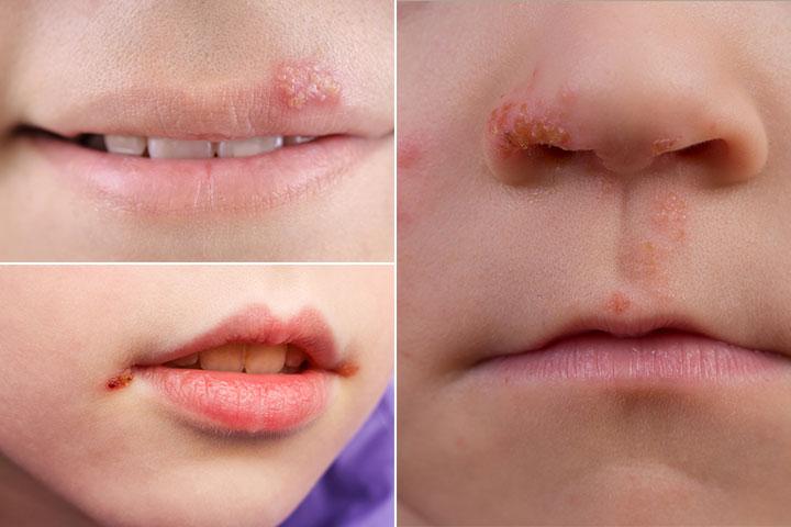 cold-sores-fever-blisters-in-kids-causes-and-treatment