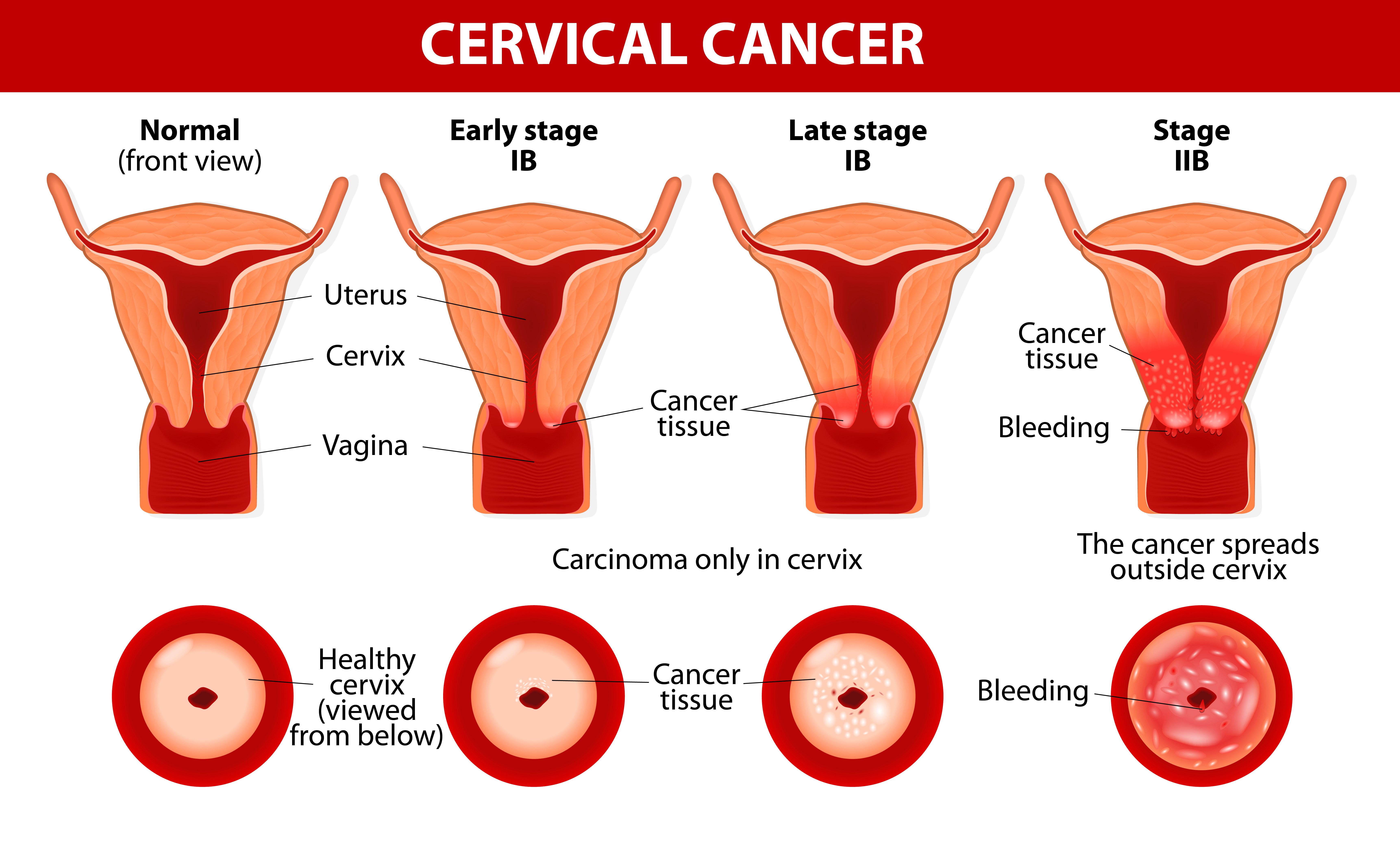 Pregnant With Cervical Cancer Pregnant With Cervical Cancer