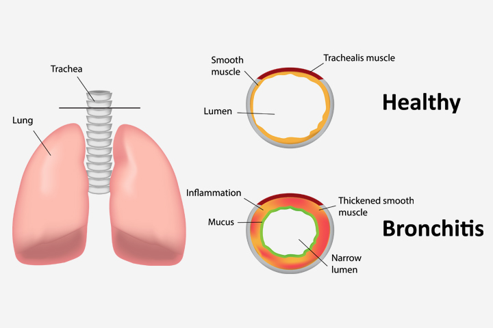 Bronchitis In Children: Causes, Symptoms And Remedies