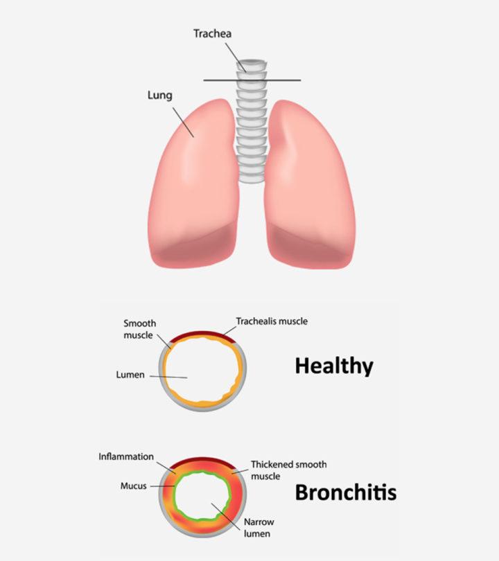 Bronchitis In Children Causes Symptoms And Remedies