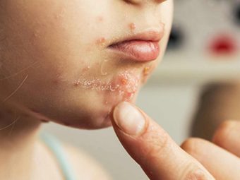 Hand, Foot, And Mouth Disease In Children: Causes, Symptoms, And Home Care