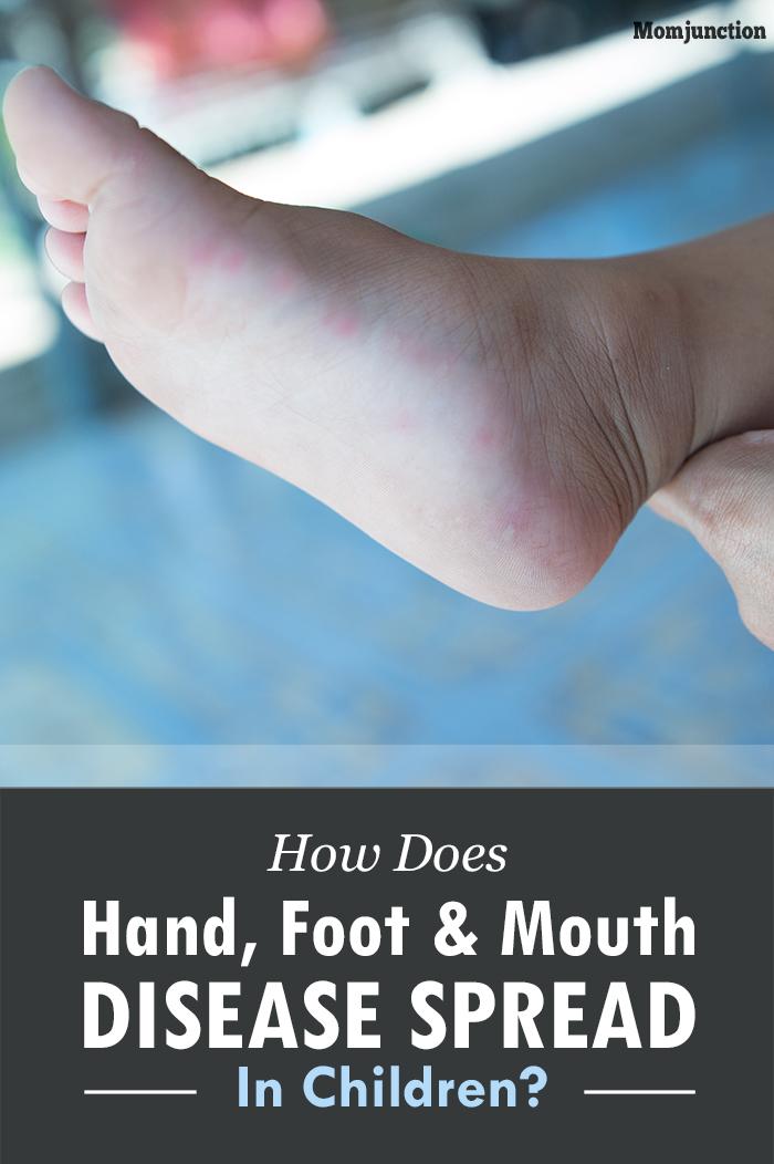 Hand, Foot, And Mouth Disease In Children: Causes, Symptoms, And Home Care