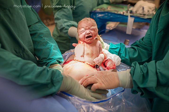 Leilani finds the C-section experiences just as breathtaking as that of natural birthing.