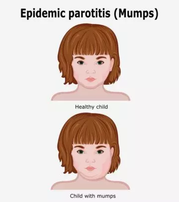 Mumps In Children
