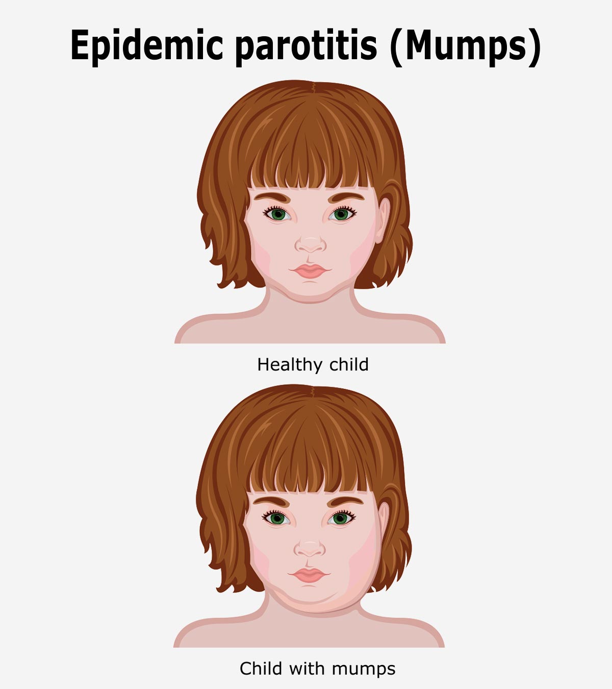 Mumps In Children: Causes, Symptoms And Home Care