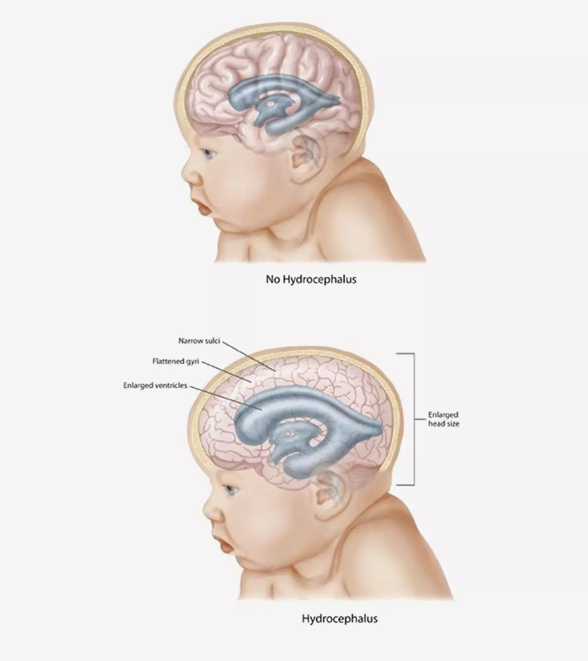 Hydrocephalus-In-Babies-Causes,-Symptoms-Treatment