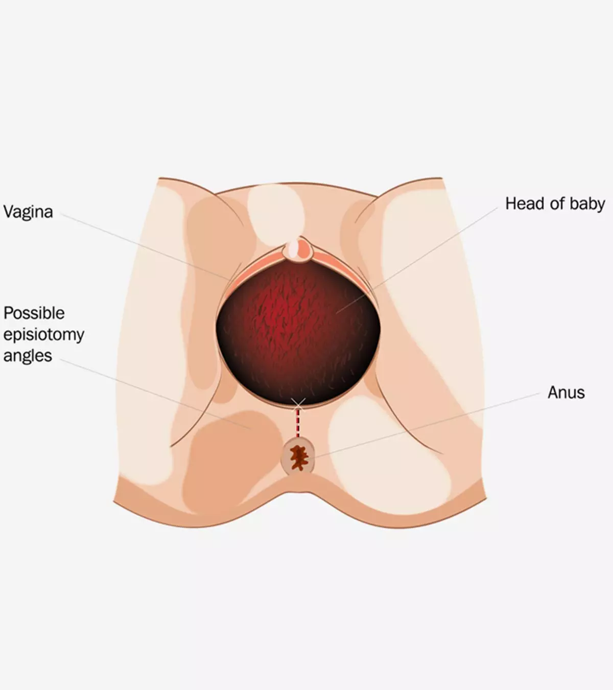 Perineal Tear - Is It Common During A Vaginal Birth