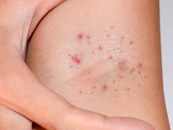 Petechiae-In-Children-Causes,-Symptoms-And-Treatment