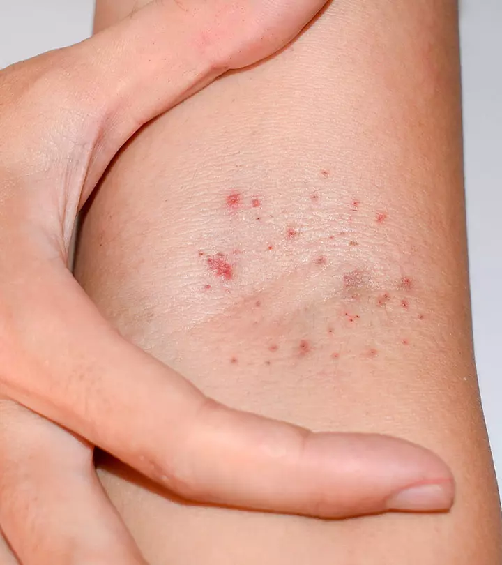Petechiae-In-Children-Causes,-Symptoms-And-Treatment