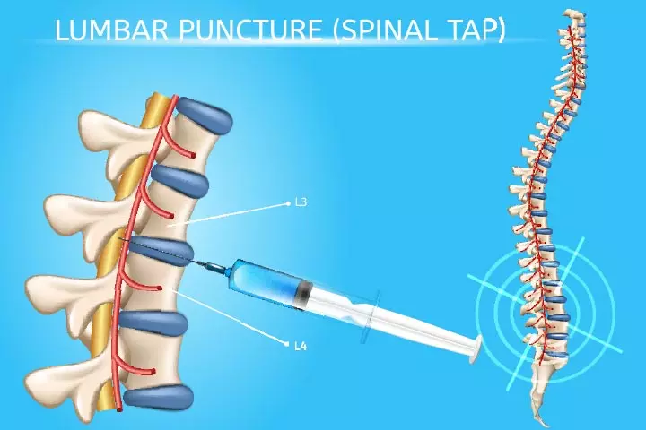 Lumbar puncture in babies