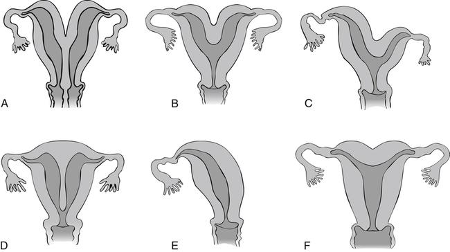 Single horn uterus