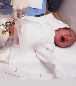 Circumcision In Baby Boys: Benefits, Drawbacks, And Prevention