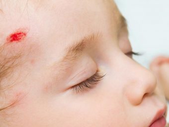 Concussion In Babies